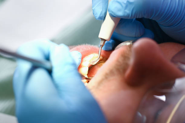 Best Emergency Root Canal Treatment in Sudley, VA