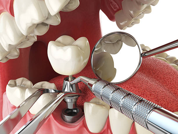Best Emergency Dental Care for Abscessed Tooth in Sudley, VA
