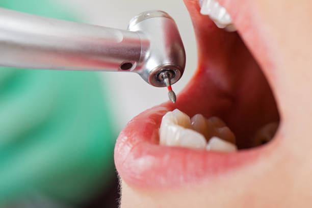 Best Emergency Dentist for Lost Fillings or Crowns in Sudley, VA